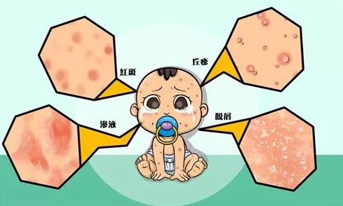 湿疹001.png